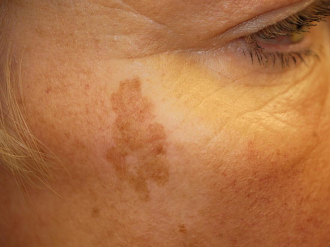 age-spot-or-liver-spot-on-the-face-br-image-credit-dermnet-new-zealand-br-2